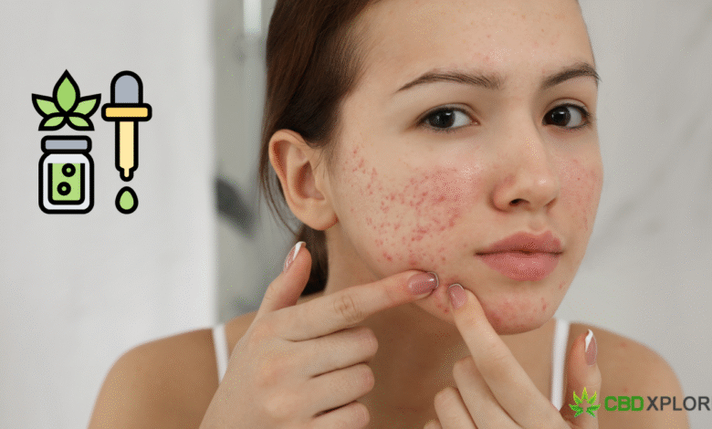 CBD for Acne