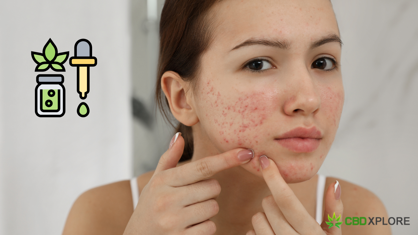 CBD for Acne