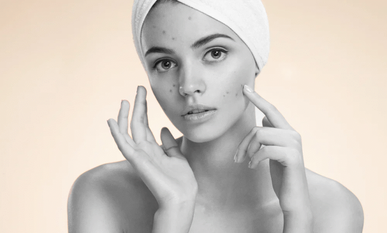 10 Best CBD Acne Treatment Tips