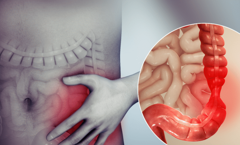 CBD Oil for IBS Relief