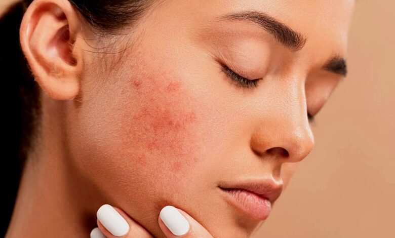 CBD Help with Acne